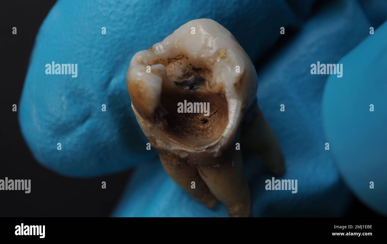Carie dentaire et main de dentiste avec gant et fond noir. Photo macro d'une dent décalées jusqu'à la racine après l'extraction du dentiste. Anatomie réelle des dents Banque D'Images