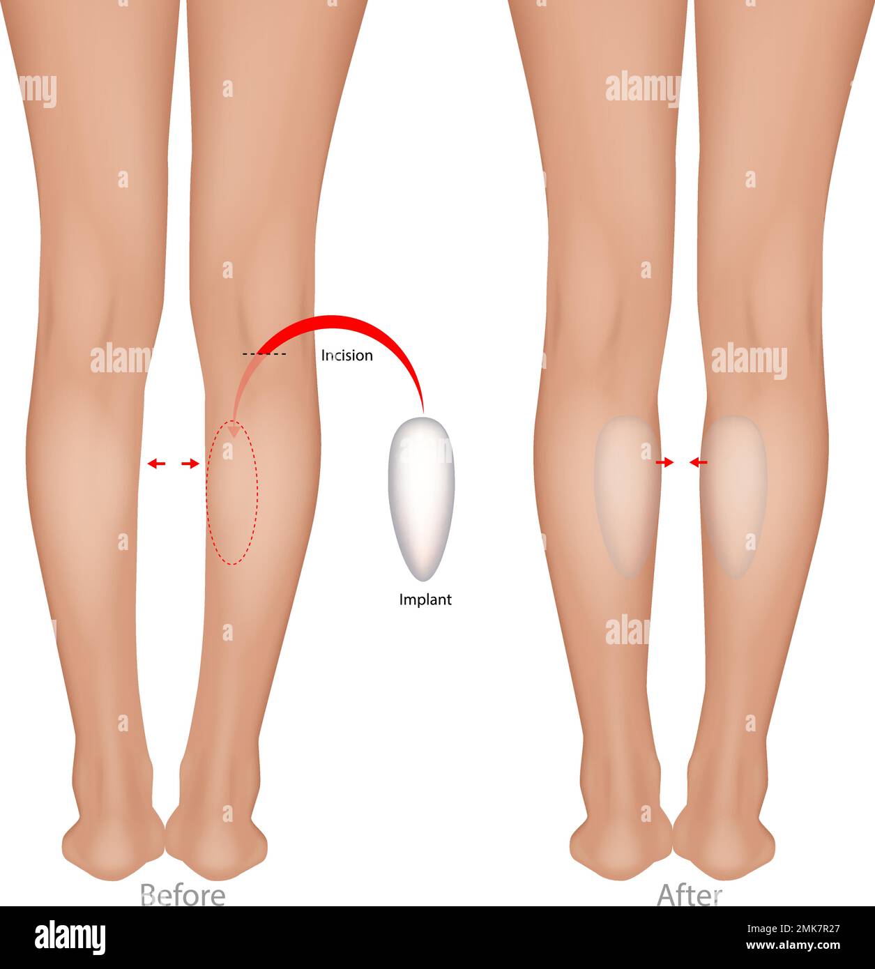 Chirurgie plastique d'augmentation du mollet. Calcul de la procédure avant et après Illustration de Vecteur