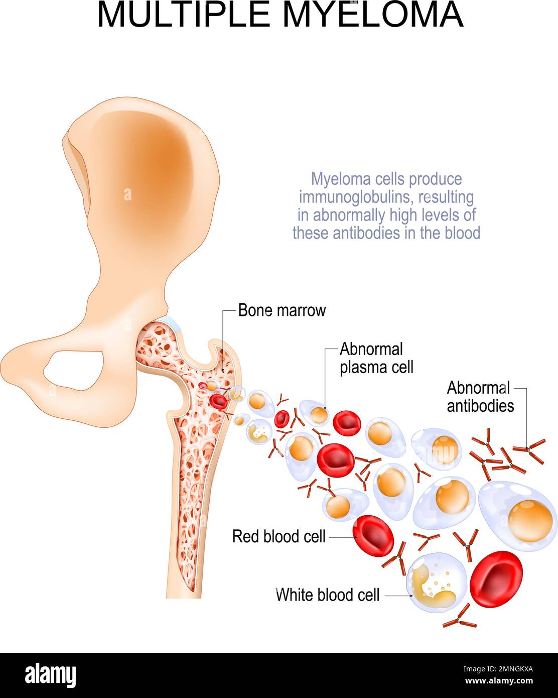 Myélome multiple. Les cellules du myélome dans la moelle osseuse produisent des immunoglobulines, ce qui entraîne des taux anormalement élevés d'anticorps dans le sang. Coupe transversale Illustration de Vecteur