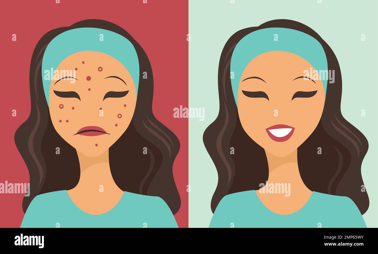 Jeune fille malheureuse luttant avec l'acné. Avant et après le traitement de la peau Illustration de Vecteur