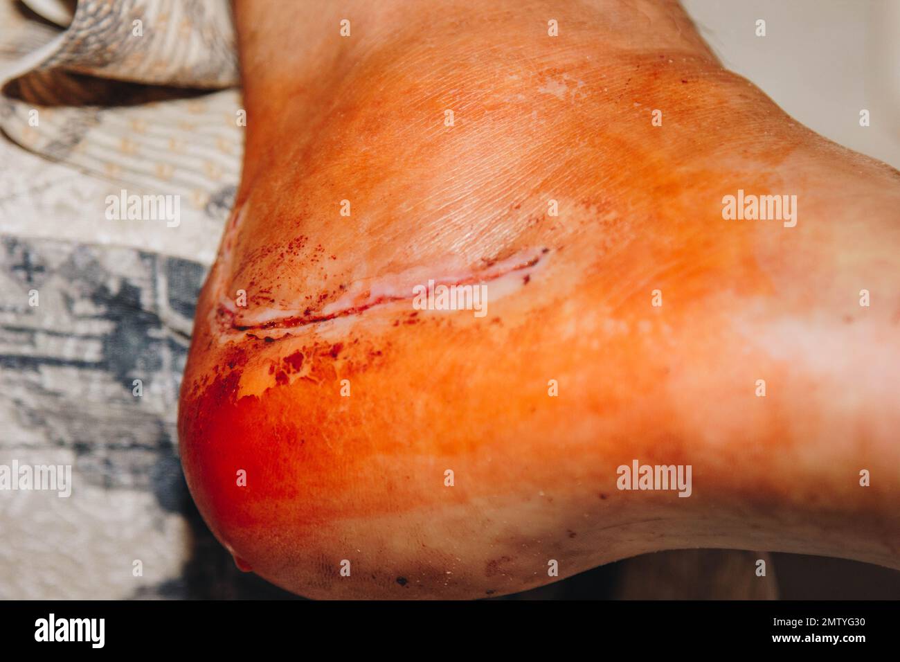 Une cicatrice sur la jambe après une opération de remplacement du ...