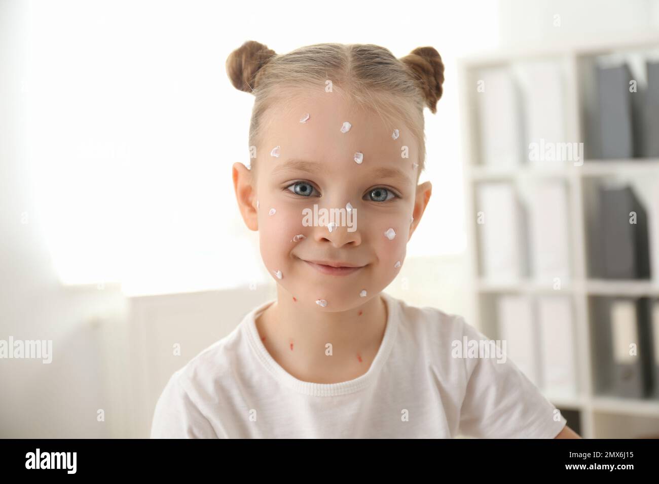 Petite fille avec la varicelle en clinique. Virus varicelle-zona Banque D'Images