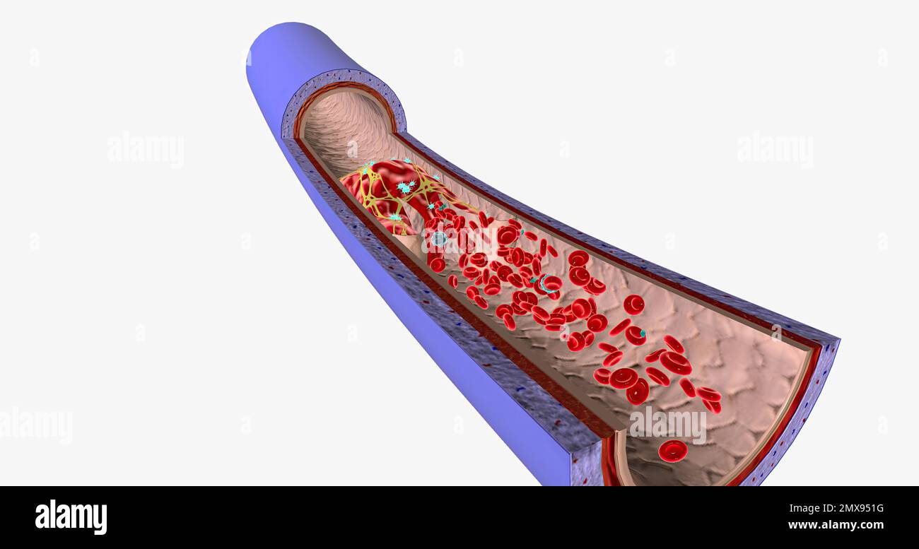 Un caillot de sang dans une veine, ou thrombus veineux, est le caillot de sang dans les