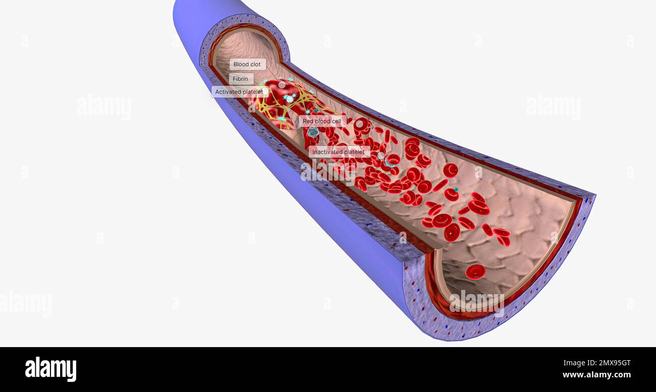 Un caillot de sang dans une veine, ou thrombus veineux, est le caillot de sang dans les
