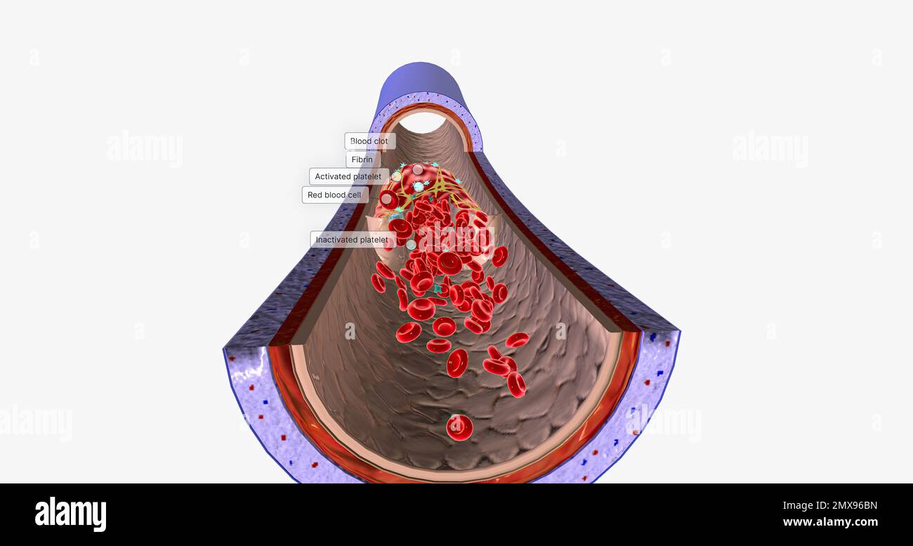 Un caillot de sang dans une veine, ou thrombus veineux, est le caillot de sang dans les