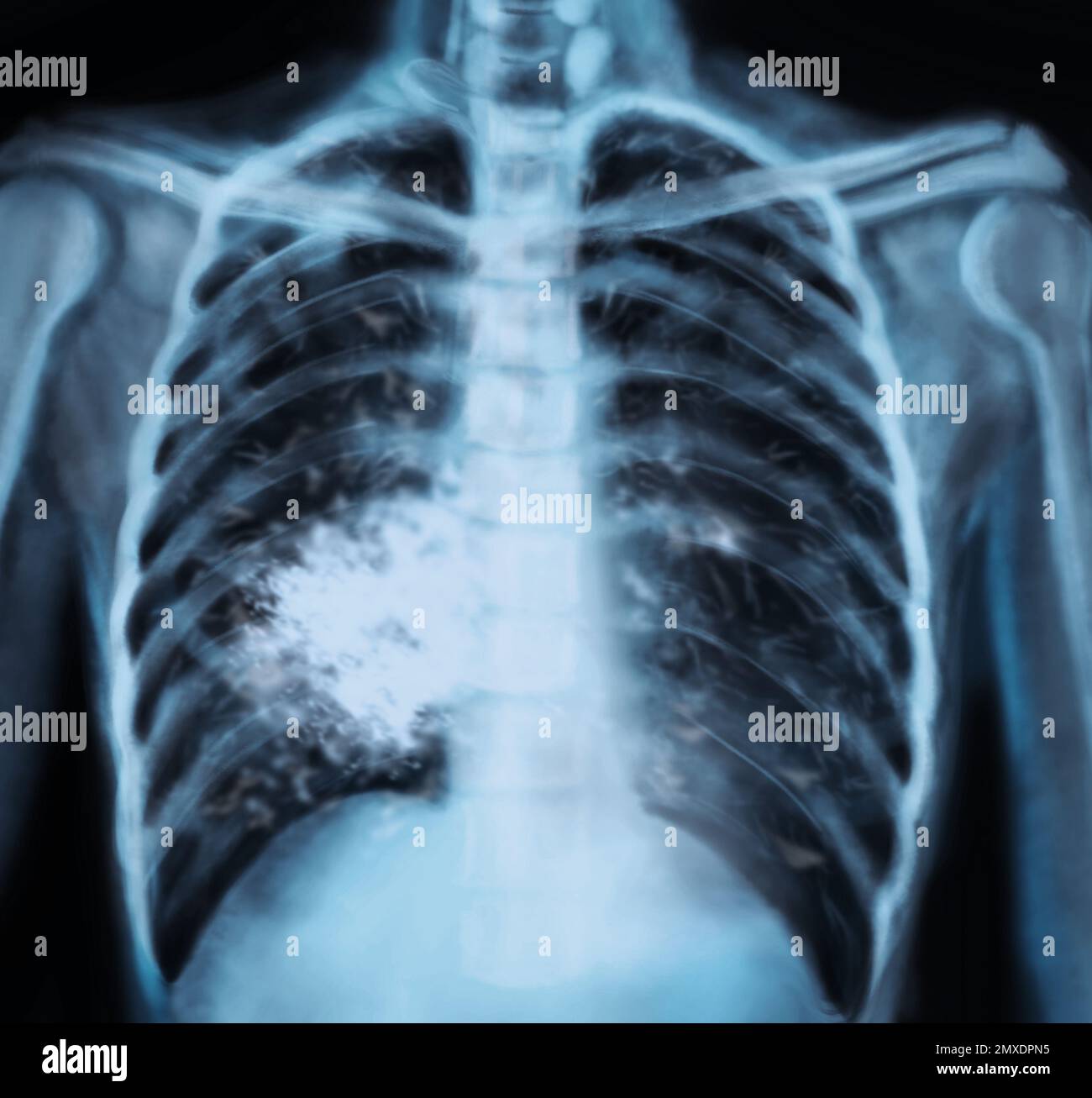Rayons X du patient atteint d'un cancer du poumon. Illustration ...