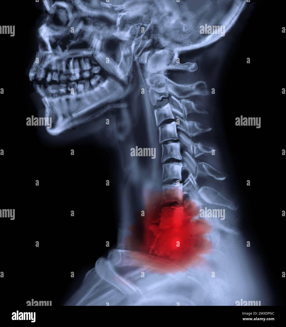 Rayons X du patient atteint d'un cancer. Illustration Banque D'Images