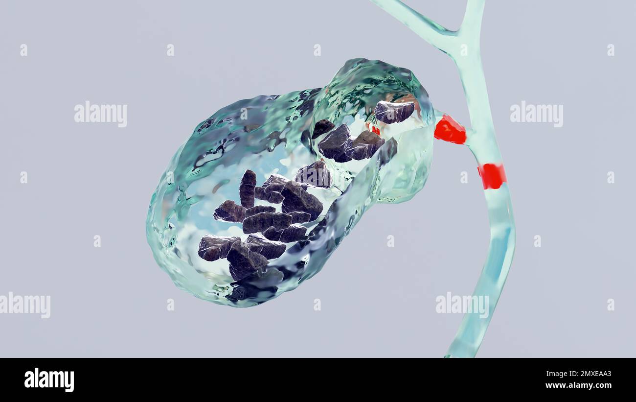 Calculs biliaires dans le canal biliaire, silhouette humaine et anatomie des organes environnants, foie et vésicule biliaire avec calculs, rendu réaliste 3D Banque D'Images