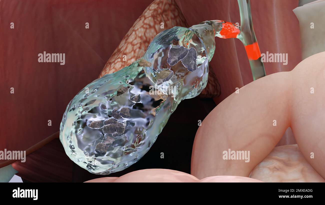 Calculs biliaires dans le canal biliaire, silhouette humaine et anatomie des organes environnants, foie et vésicule biliaire avec calculs, rendu réaliste 3D Banque D'Images