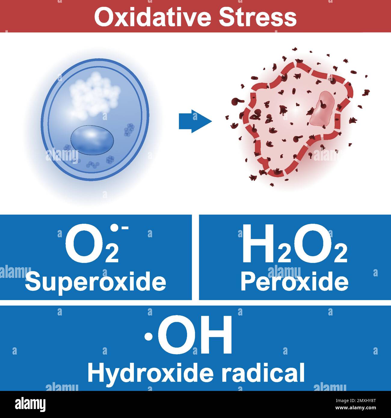 Facteurs de stress oxydatif, cellule saine est attaqué par les radicaux libres. Superoxyde, peroxyde, radical hydroxyde. Illustration de vecteur médical Illustration de Vecteur