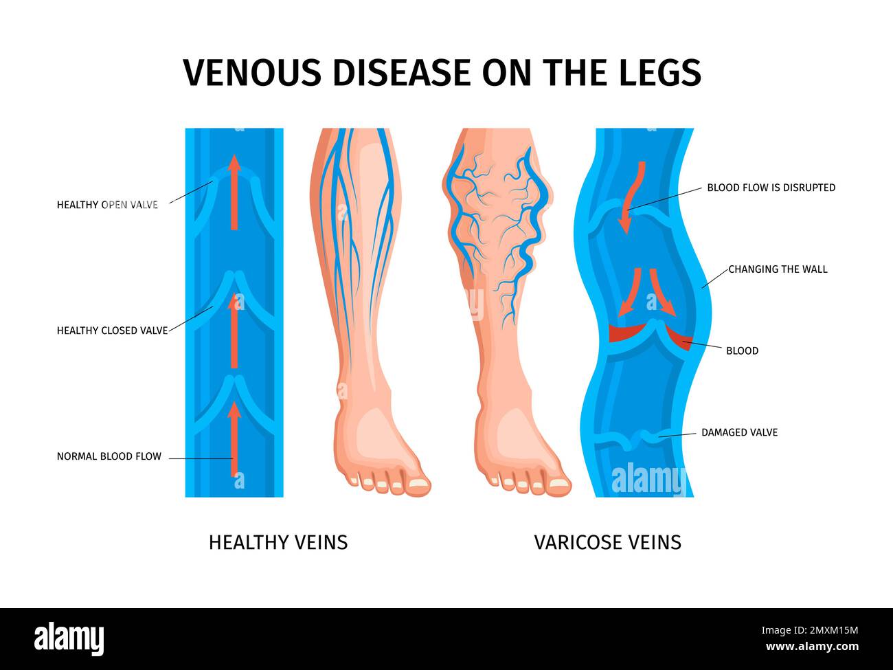 Maladie veineuse des jambes schéma infographique du flux sanguin dans