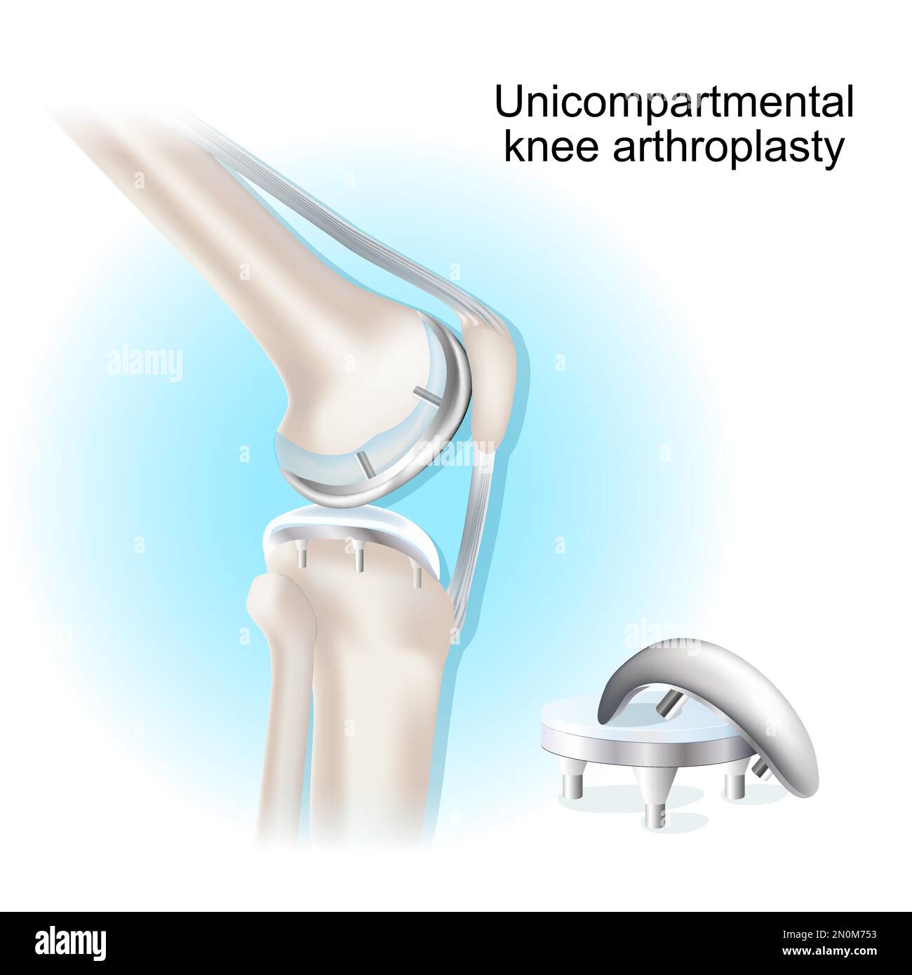 Arthroplastie du genou unicompartiale. procédure chirurgicale pour le traitement ou le soulagement de l'arthrite, après joint endommagé. implant uni pour genou. Remplacement partiel du genou Illustration de Vecteur