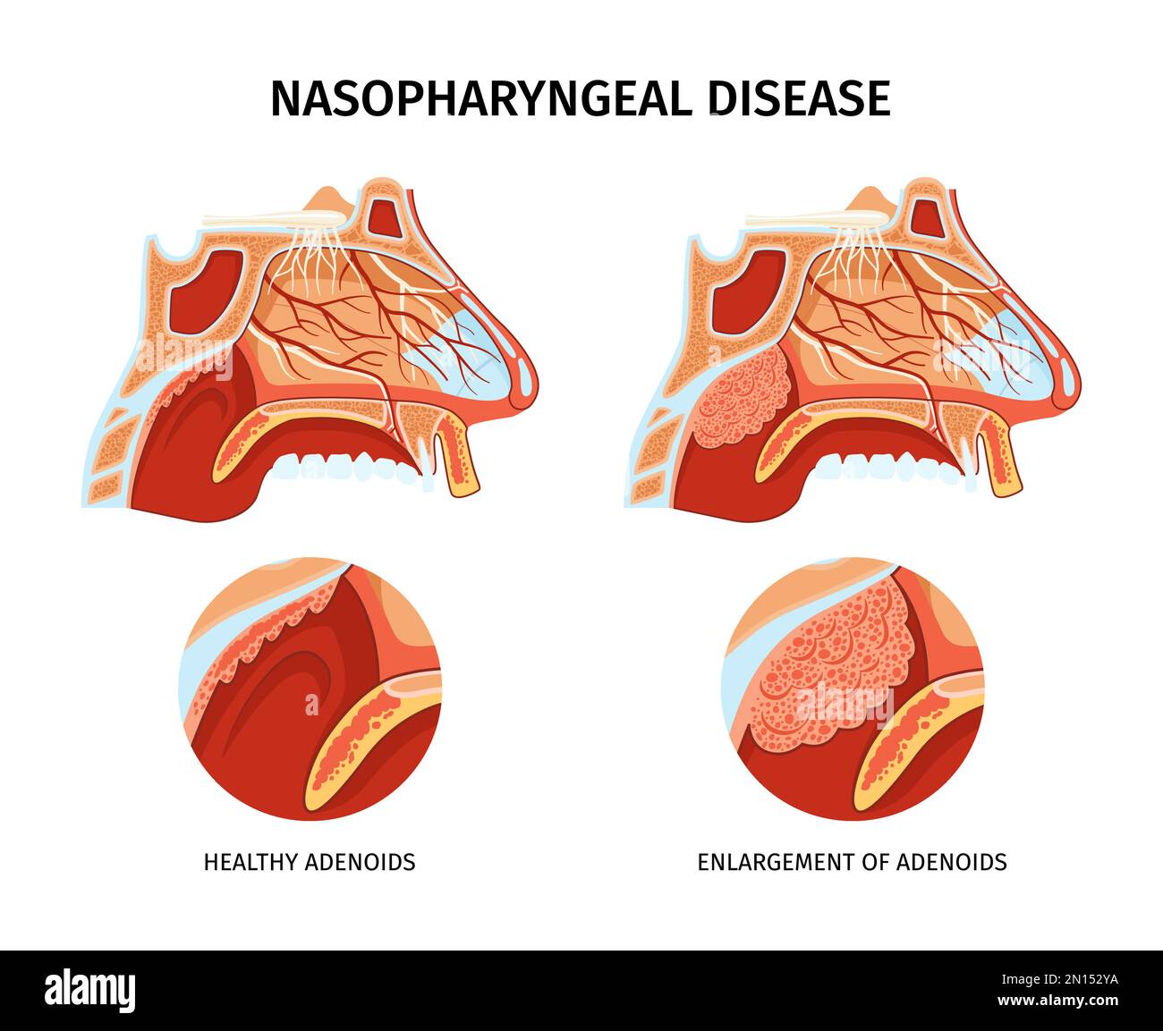 Affiche de la maladie nasopharyngée avec les vaisseaux sanguins nerfs sinus paranasaux sain et élargi adénoïdes et illustration de vecteur plat Illustration de Vecteur