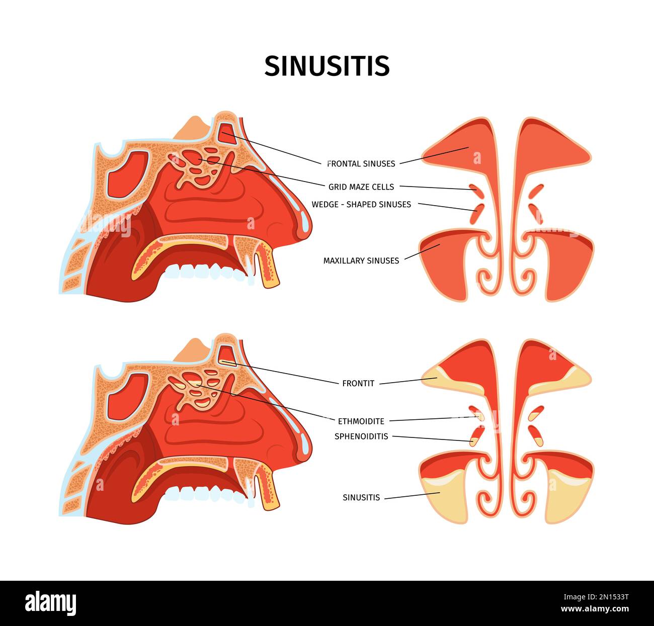 Affiche de section transversale d'infographies de sinusite représentant l'inflammation des sinus paranasaux, y compris les cellules de labyrinthe maxillaires frontal et de grille réaliste Illustration de Vecteur