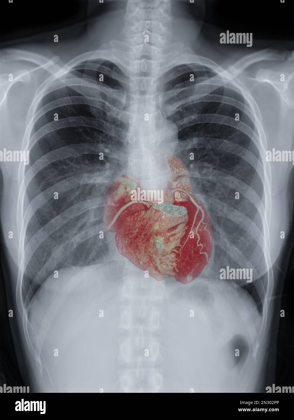 Image de fusion de l'image radiographique thoracique et de l'artère coronaire 3D CTA pour le diagnostic de dépistage de la tuberculose, de la tuberculose et du covid-19. Banque D'Images