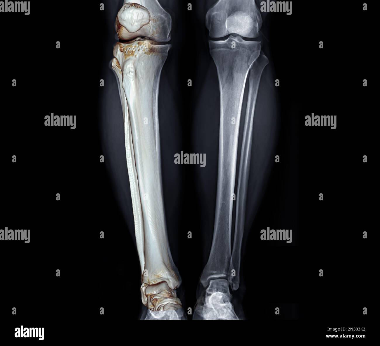 Image radiographique de la vue AP des deux jambes avec 3D jambes pour la fracturation diagnostique du genou. Banque D'Images Image radiographique de la vue AP des deux jambes avec 3D jambes pour la fracturation diagnostique du genou. Banque D'Images