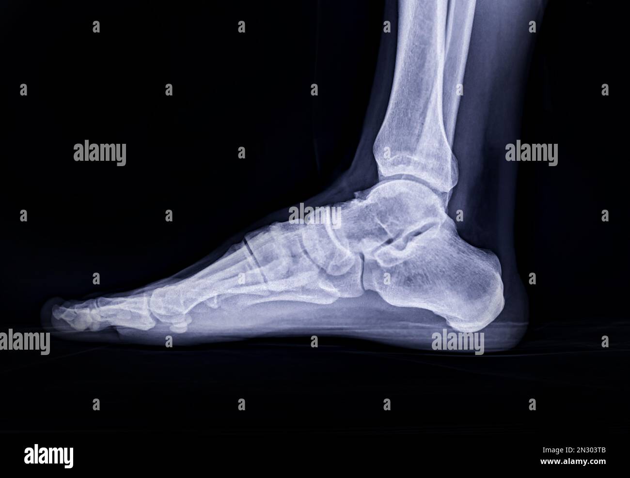 Image radiographique du pied vue latérale isolée sur fond noir. Banque D'Images