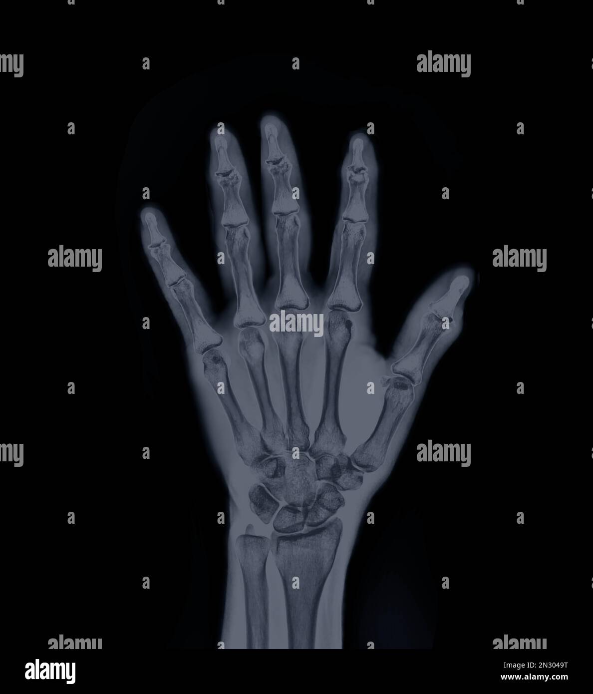 La vue AP gauche du film radiographique montre les mains de l'homme isolées sur fond noir . Banque D'Images