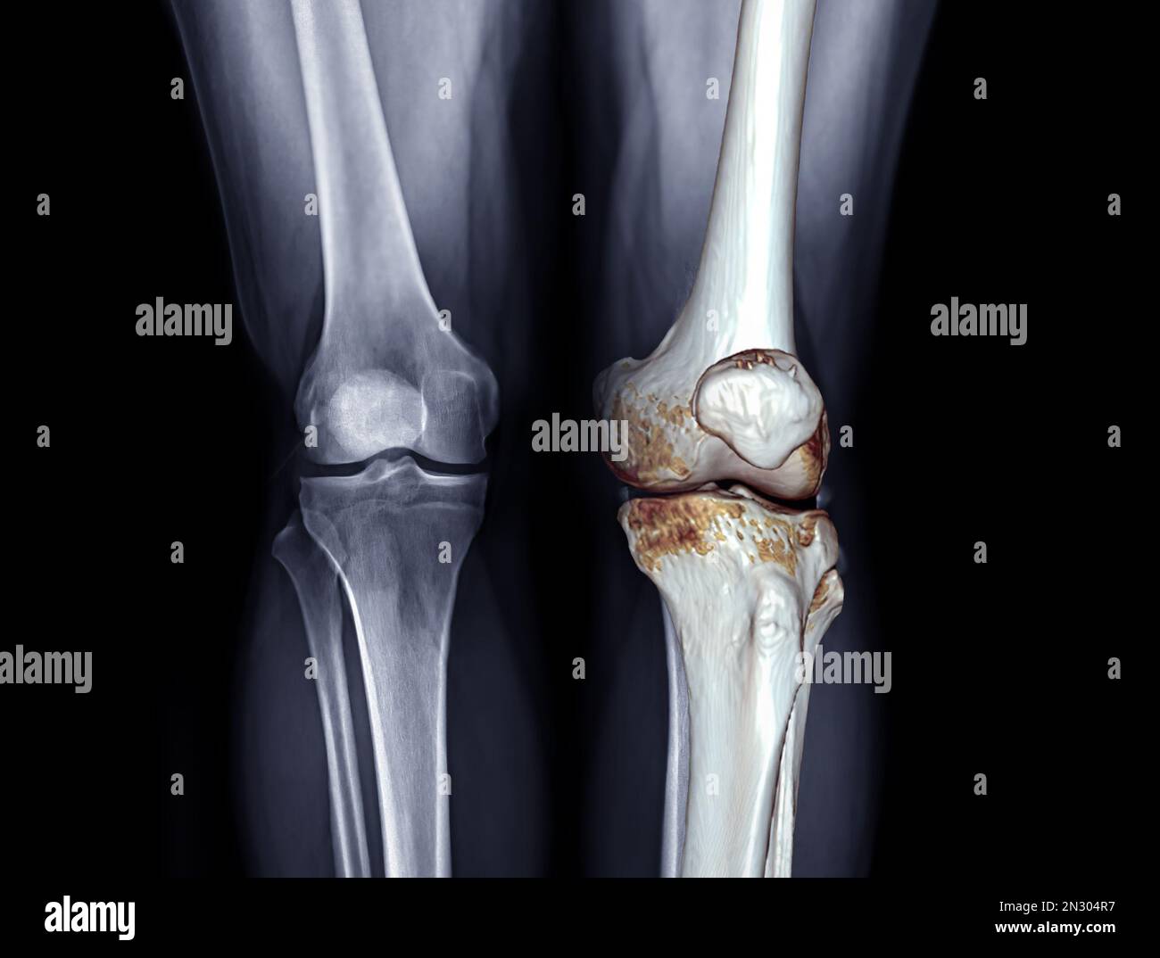 Image radiographique des deux vues AP du genou pour diagnostic d'arthrose ou de fracturation du genou. Banque D'Images Image radiographique des deux vues AP du genou pour diagnostic d'arthrose ou de fracturation du genou. Banque D'Images