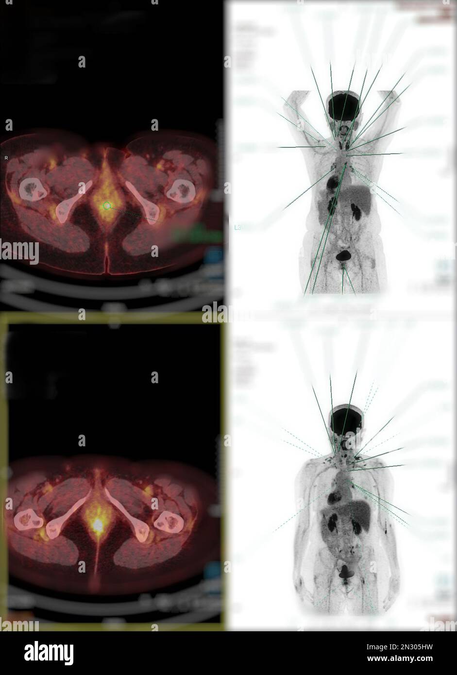 La tomographie par émission de positrons (TEP) CT scan utilise un médicament radioactif (traceur) pour montrer l'activité métabolique normale et anormale de tout le corps humain Banque D'Images