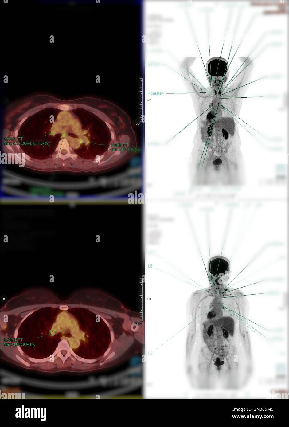 La tomographie par émission de positrons (TEP) CT scan utilise un
