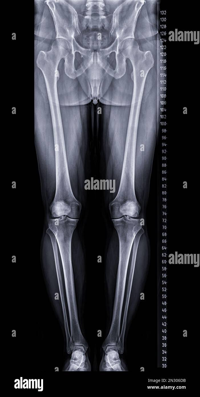 Scanogramme est une radiographie AP debout sur toute la longueur des deux membres inférieurs, y compris la hanche, le genou et la cheville. Banque D'Images Scanogramme est une radiographie AP debout sur toute la longueur des deux membres inférieurs, y compris la hanche, le genou et la cheville. Banque D'Images