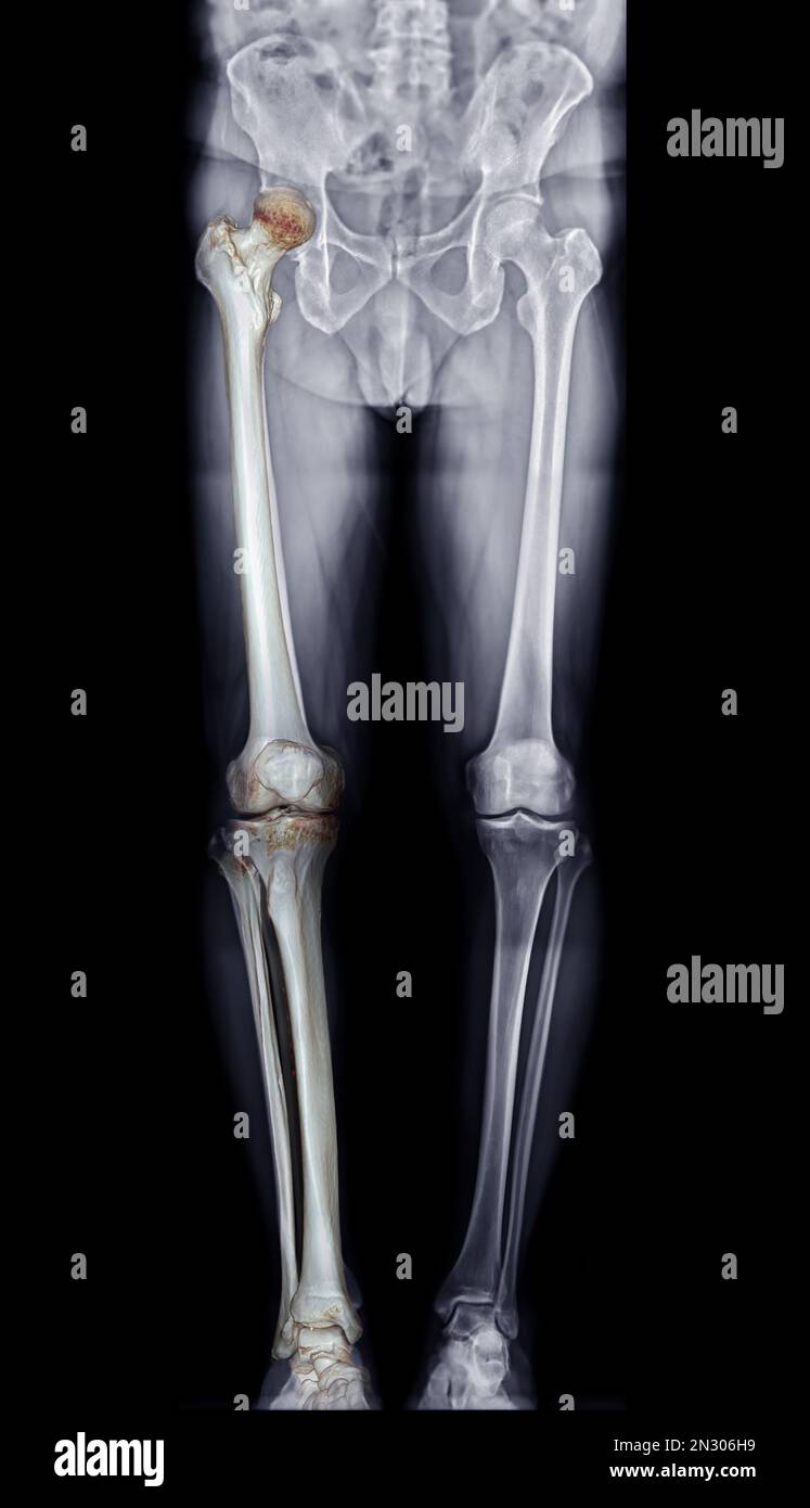 Scanogramme est une radiographie AP debout sur toute la longueur des deux membres inférieurs, y compris la hanche, le genou et la cheville avec rendu 3D. Banque D'Images Scanogramme est une radiographie AP debout sur toute la longueur des deux membres inférieurs, y compris la hanche, le genou et la cheville avec rendu 3D. Banque D'Images