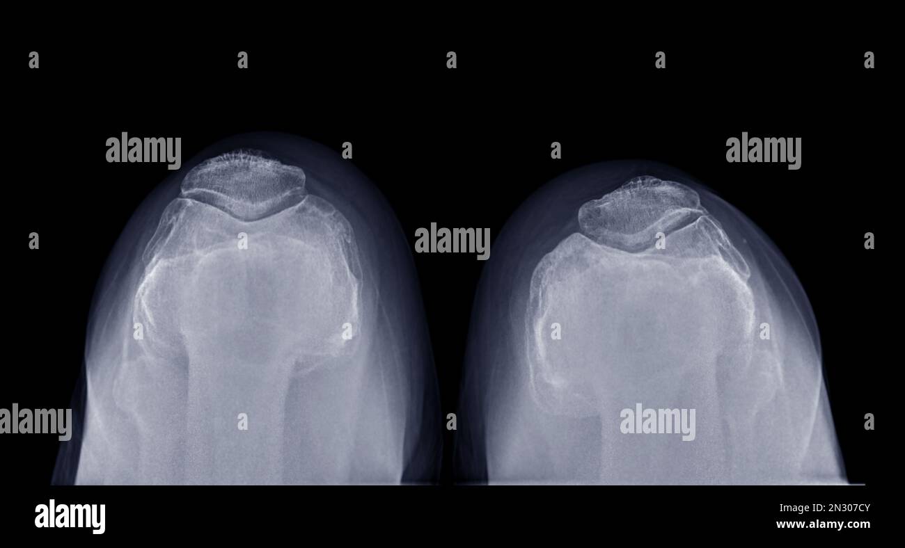 Image par rayons X des deux fractures de rotule pour une fracture de rotule diagnostique ou une luxation de rotule. Banque D'Images Image par rayons X des deux fractures de rotule pour une fracture de rotule diagnostique ou une luxation de rotule. Banque D'Images