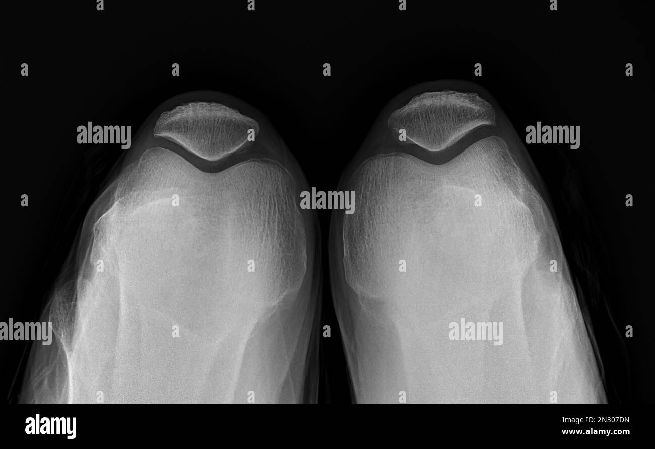 Image par rayons X des deux fractures de rotule pour une fracture de rotule diagnostique ou une luxation de rotule. Banque D'Images Image par rayons X des deux fractures de rotule pour une fracture de rotule diagnostique ou une luxation de rotule. Banque D'Images