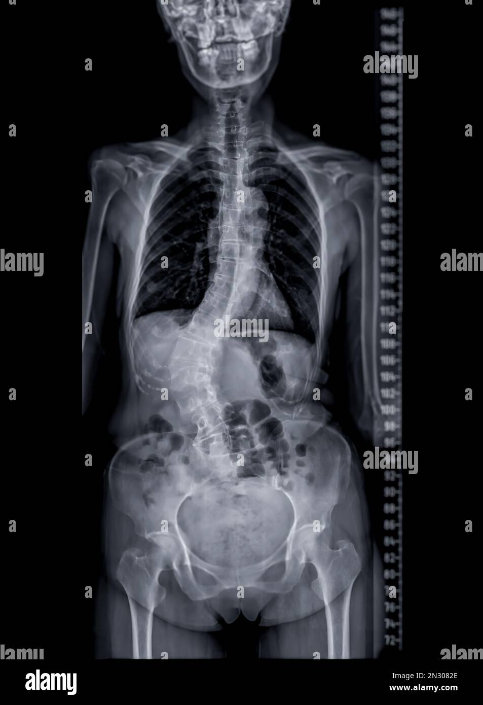 Image radiographique de la colonne vertébrale entière pour le diagnostic de scoliose de la colonne vertébrale. Banque D'Images