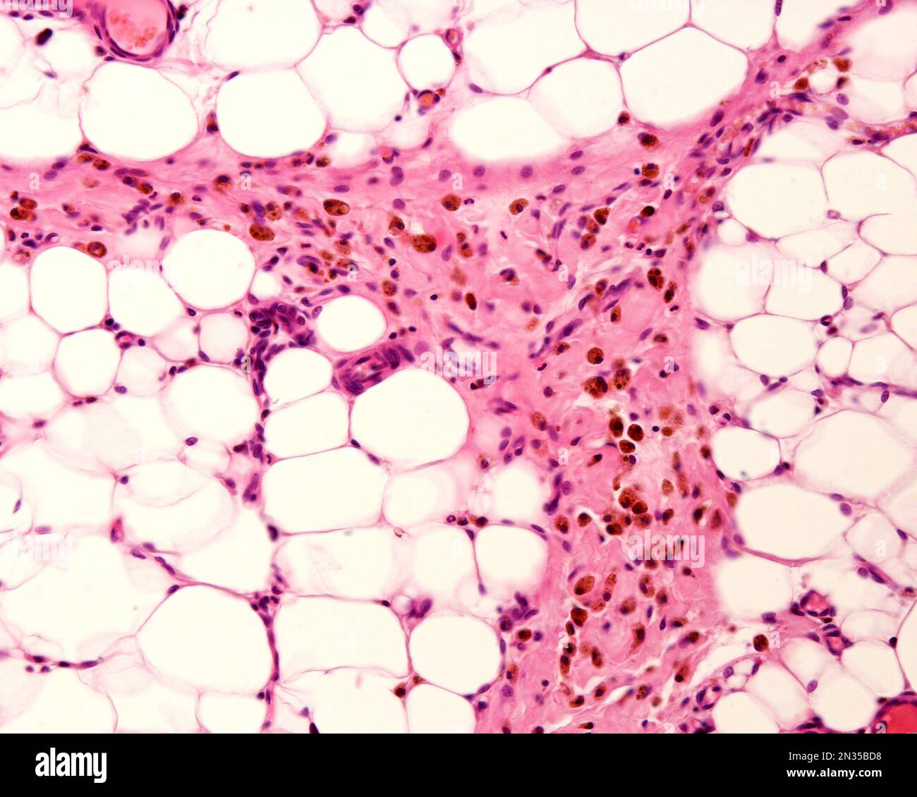 Graisse péritonéale montrant des macrophages marqués avec du fer colloïdal. Le fer colloïdal peut être utilisé comme coloration vitale pour marquer les macrophages. Circulation colloïdale Banque D'Images