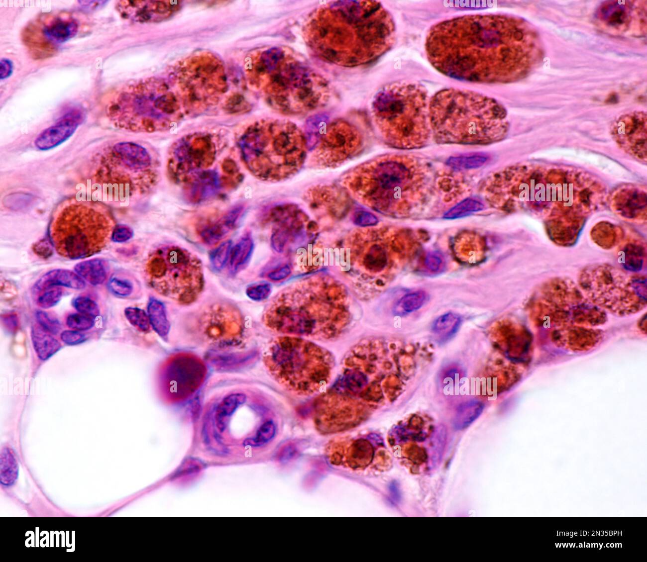 Macrophages fortement marqués avec du fer colloïdal. Le fer colloïdal peut être utilisé comme coloration vitale pour marquer les macrophages. Le fer colloïdal circulant est phago Banque D'Images