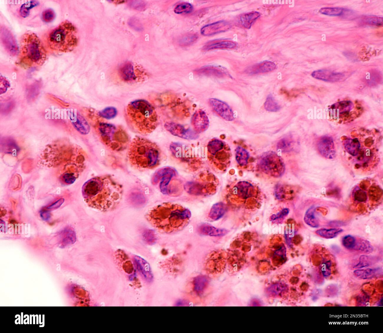 Macrophages fortement marqués avec du fer colloïdal. Le fer colloïdal peut être utilisé comme coloration vitale pour marquer les macrophages. Le fer colloïdal circulant est phago Banque D'Images