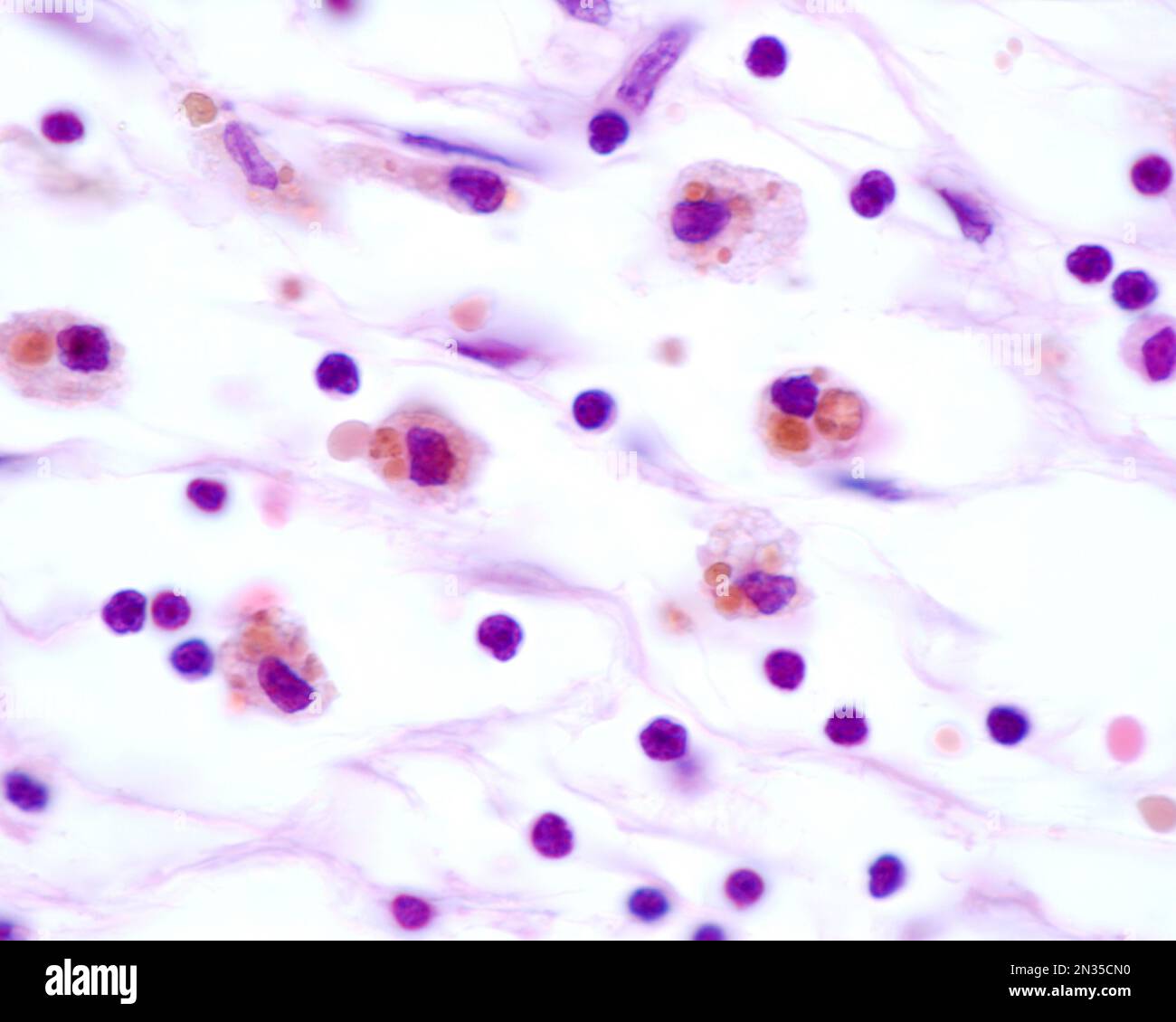 Les macrophages présentant de grandes inclusions brunes proviennent de la phagocytose des globules rouges après une hémorragie Banque D'Images