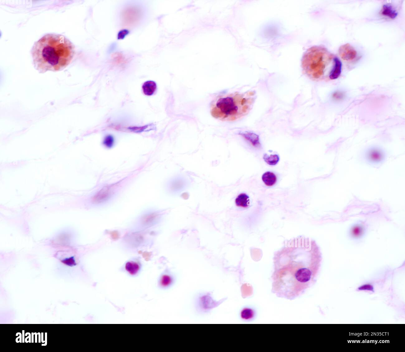 Les macrophages présentant de grandes inclusions brunes proviennent de la phagocytose des globules rouges après une hémorragie Banque D'Images