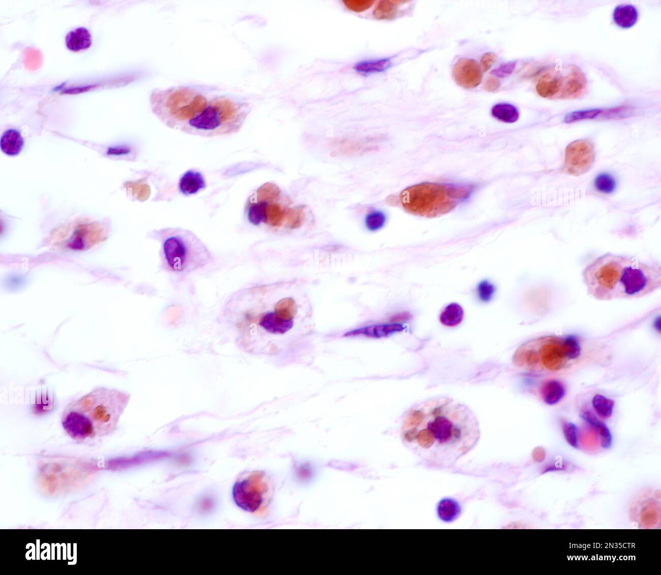Les macrophages présentant de grandes inclusions brunes proviennent de la phagocytose des globules rouges après une hémorragie Banque D'Images