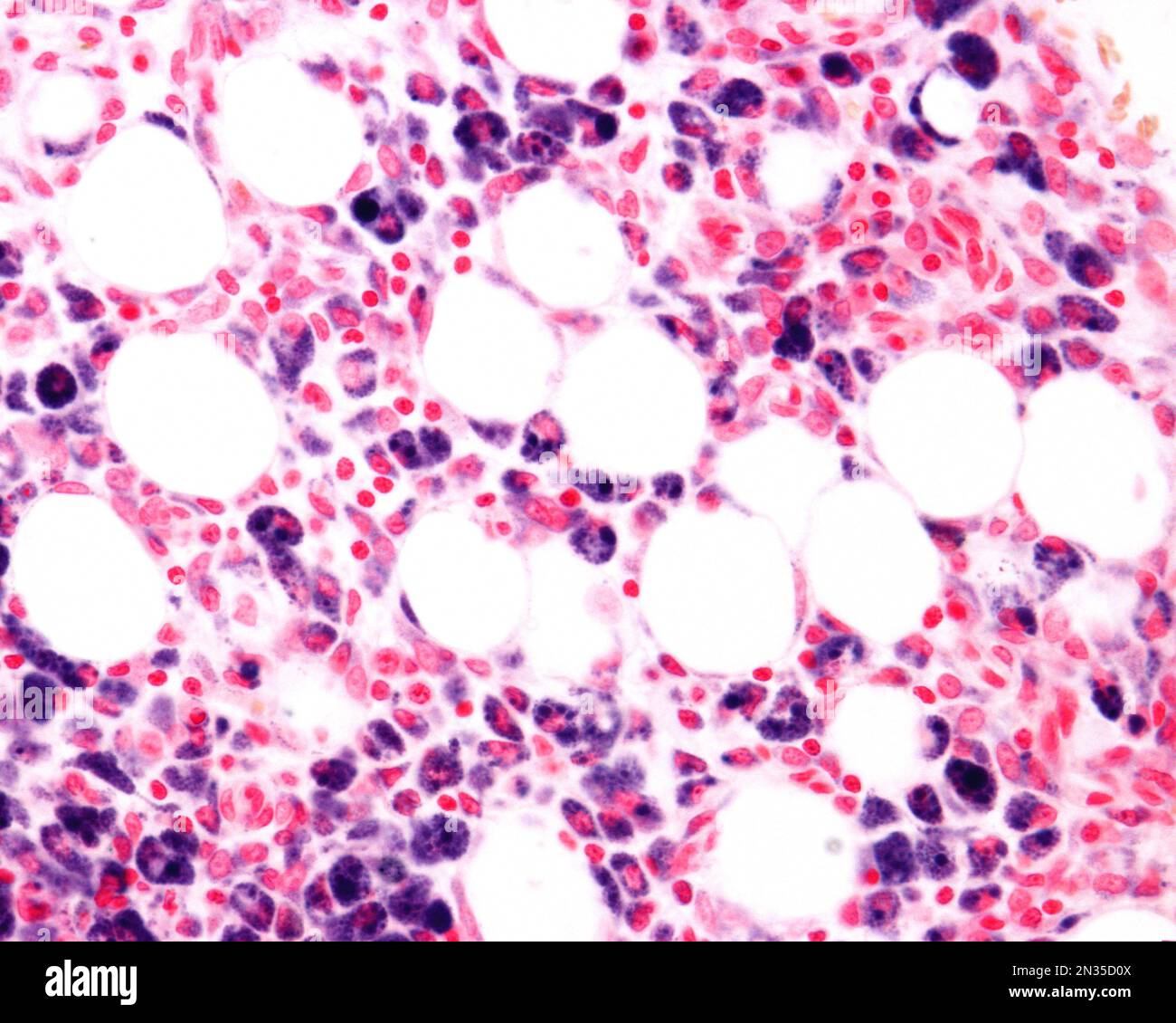 Macrophages d'une zone d'inflammation fortement marquée avec le bleu de Trypane une coloration vitale qui peut être introduite dans le corps. Le bleu de trypan circulant est phago Banque D'Images