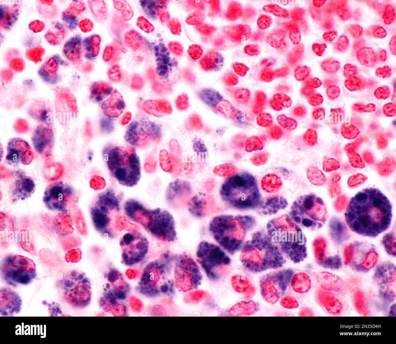 Micrographe à fort grossissement montrant les macrophages d'une zone d'inflammation fortement marquée par le bleu de Trypas. Le bleu de trypan est une tache vitale qui peut être dedans Banque D'Images