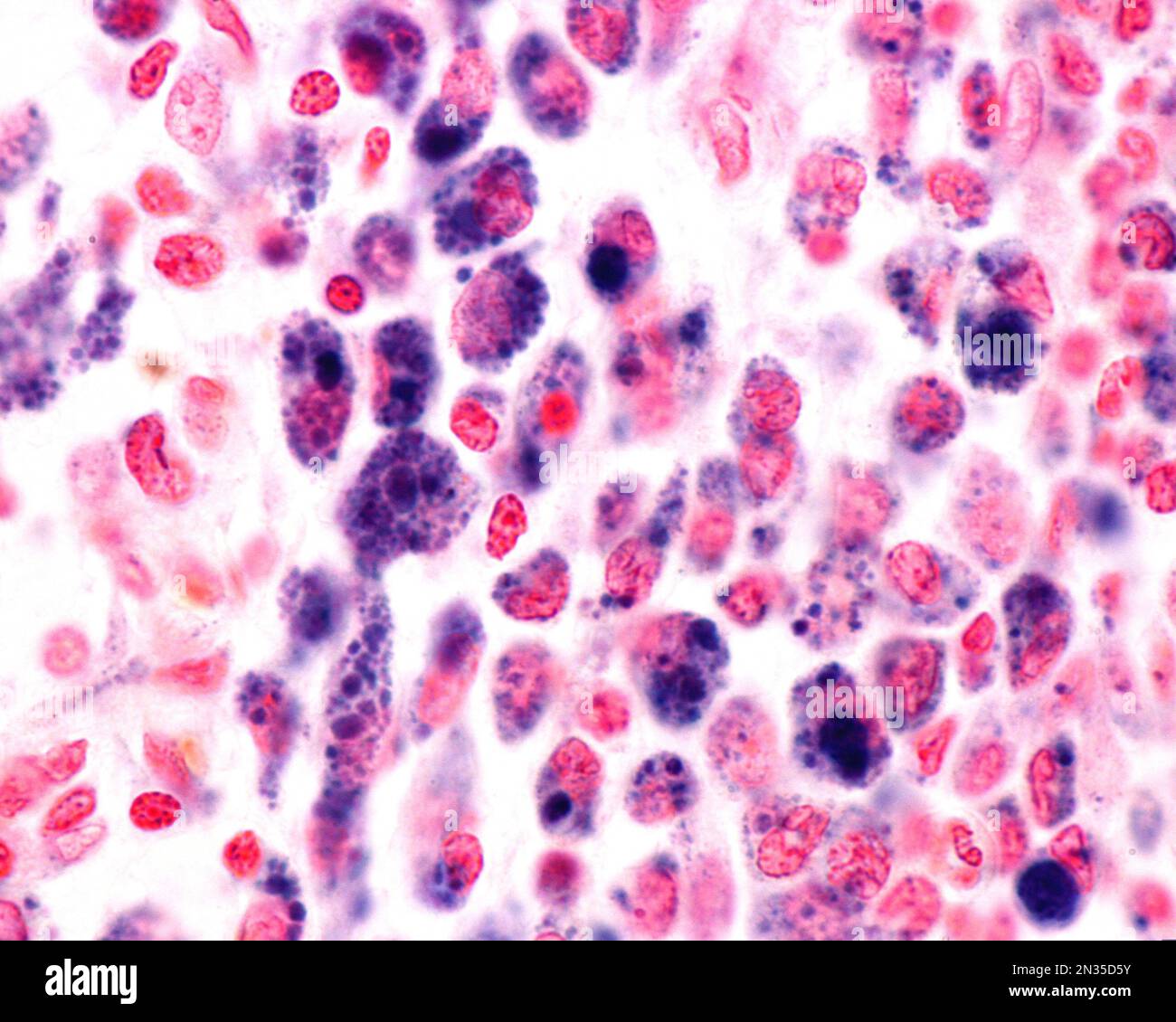 Micrographe à fort grossissement montrant les macrophages d'une zone d'inflammation fortement marquée par le bleu de Trypas. Le bleu de trypan est une tache vitale qui peut être dedans Banque D'Images
