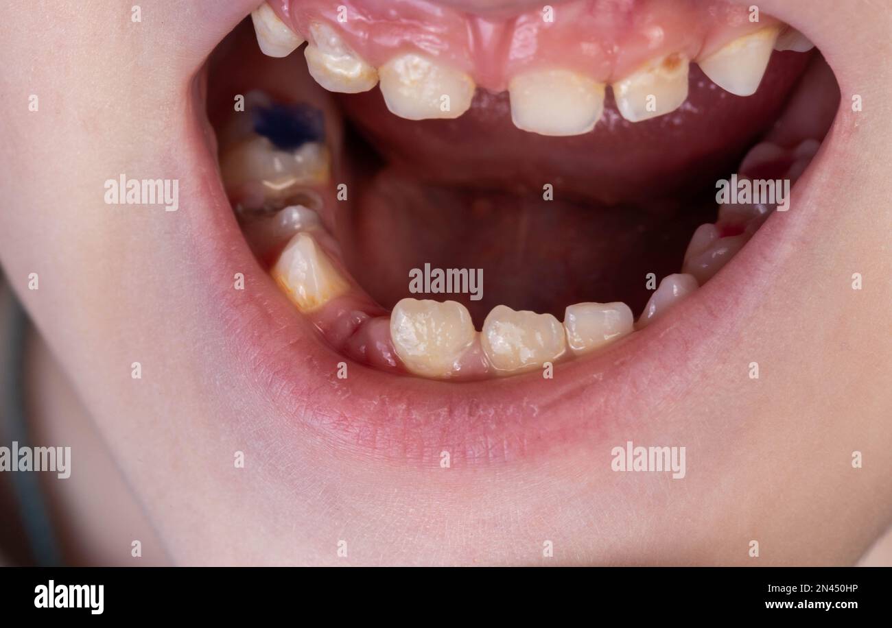 Le sourire d'une fille sans dent. Extraction des dents de lait chez les enfants. Banque D'Images
