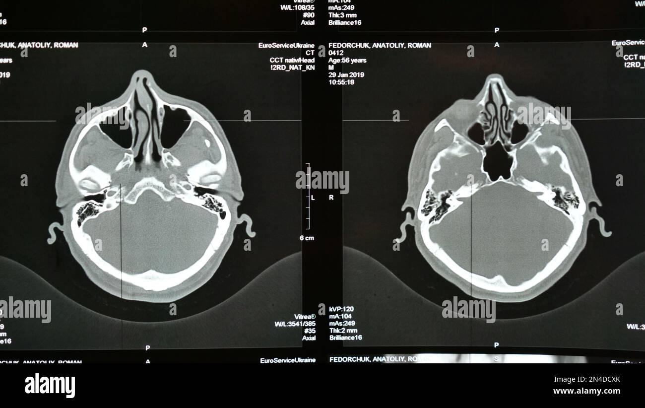 Rayons X du cerveau en cas de blessure à la tête, d'accident vasculaire cérébral chez un adulte âgé. Imagerie par résonance magnétique, IRM en gros plan pendant l'examen par un médecin dans un hôpital. Examen par un neurologue Banque D'Images