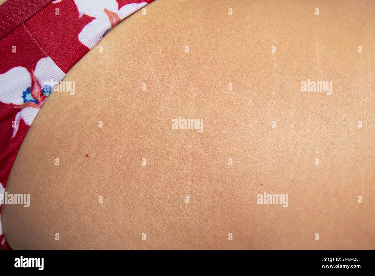 Gros plan d'une femme avec des marques d'étirement sur ses cuisses - maternité et maternité après la naissance. Banque D'Images Gros plan d'une femme avec des marques d'étirement sur ses cuisses - maternité et maternité après la naissance. Banque D'Images