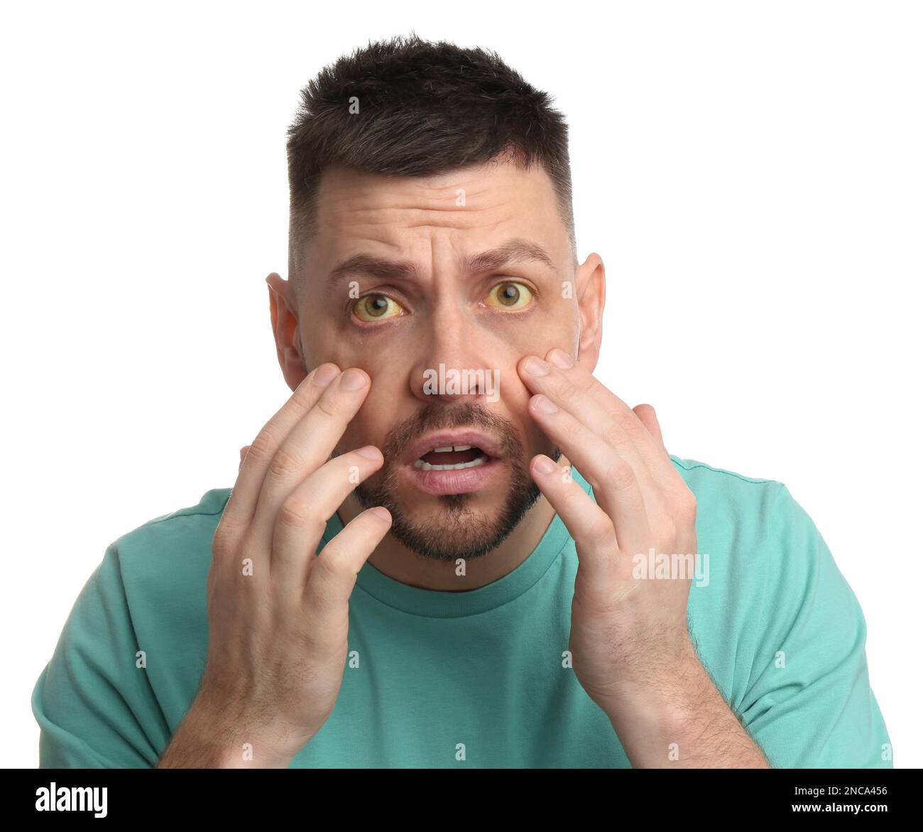 Homme effrayé vérifiant son état de santé sur fond blanc. Yeux jaunes comme symptôme de problèmes avec le foie Banque D'Images