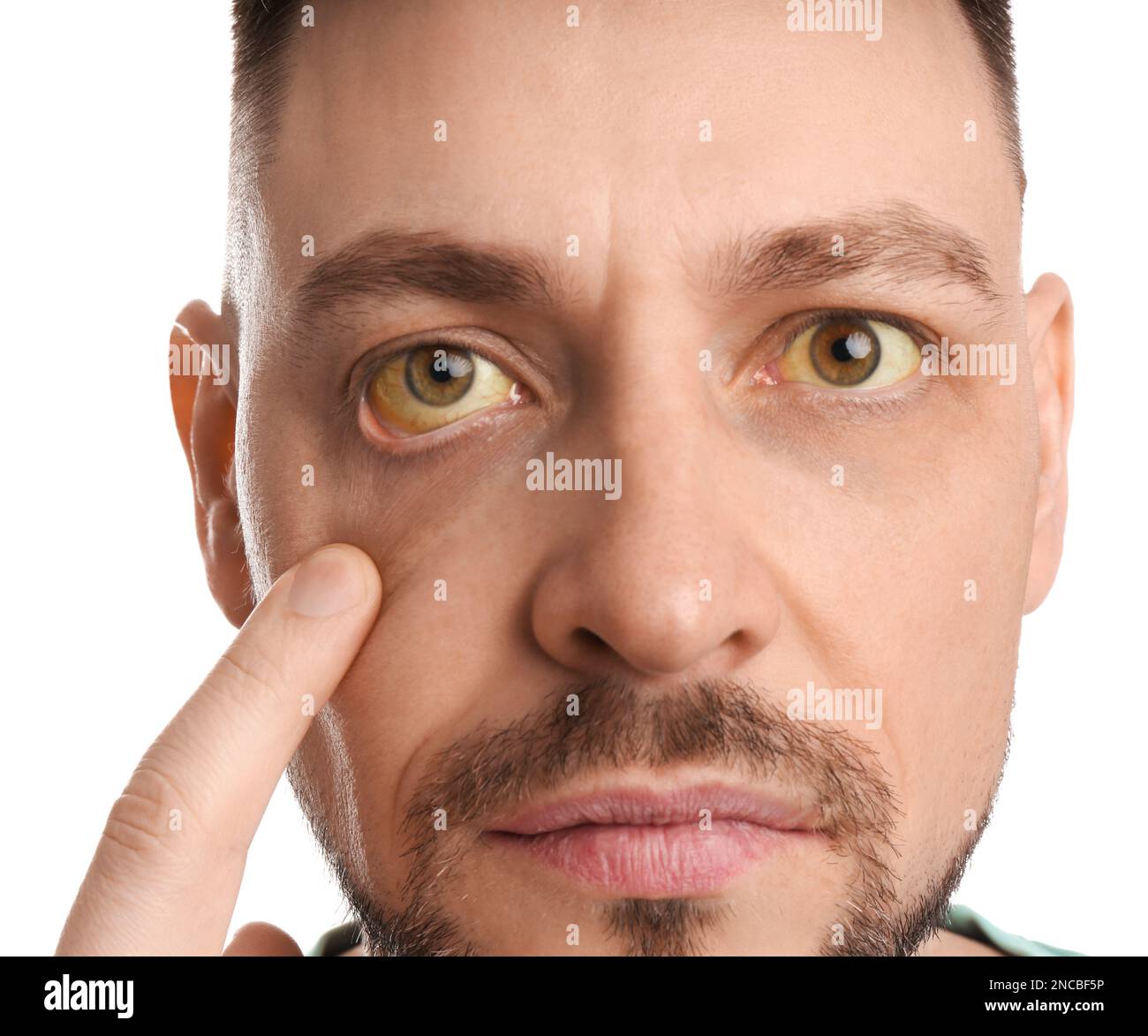 Homme vérifiant son état de santé sur fond blanc, gros plan. Yeux jaunes comme symptôme de problèmes avec le foie Banque D'Images