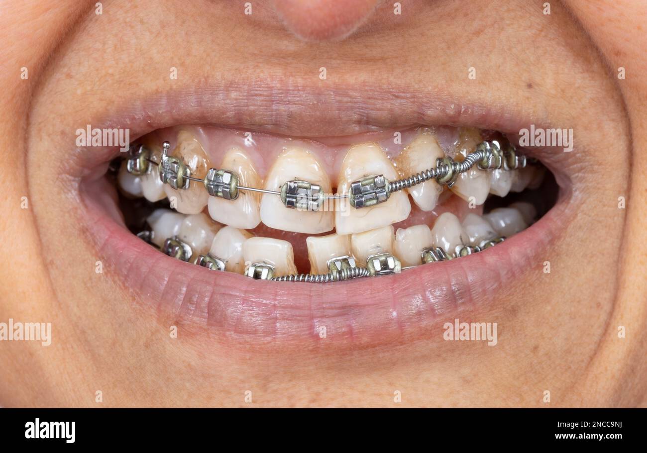 Accolades métalliques sur les dents d'une femme indienne d'âge moyen (asiatique britannique), bouche seulement. Banque D'Images
