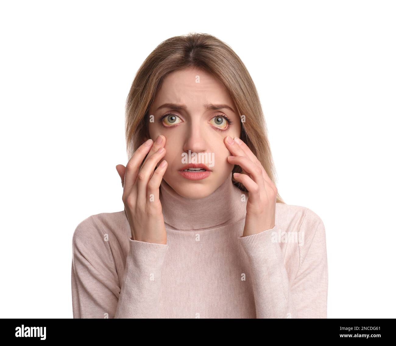 Femme vérifiant son état de santé sur fond blanc. Yeux jaunes comme symptôme de problèmes avec le foie Banque D'Images
