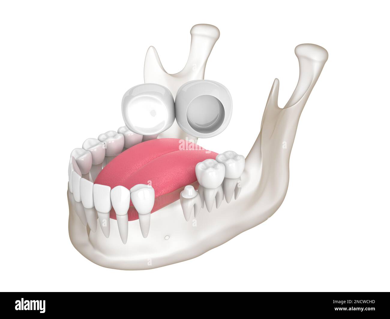 3d rendu de la mandibule avec pont en porte-à-faux dentaire sur fond blanc Banque D'Images