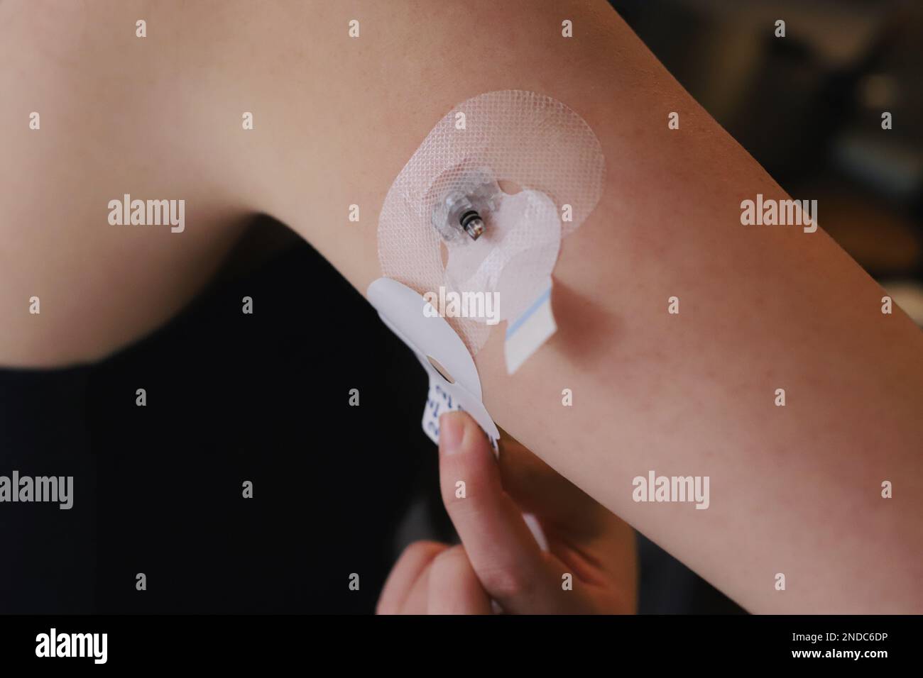 Application de l'autocollant du capteur de glycémie Banque D'Images