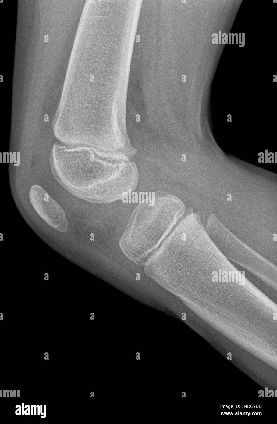 Image radiographique d'un genou en projection latérale d'une jeune fille de cinq ans. Un petit œdème est présent, indiquant une inflammation possible. Banque D'Images