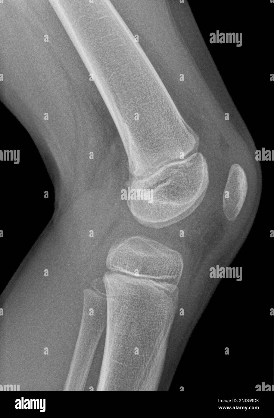 Image radiographique d'un genou en projection latérale d'une jeune fille de cinq ans. Un petit œdème est présent, indiquant une inflammation possible. Banque D'Images